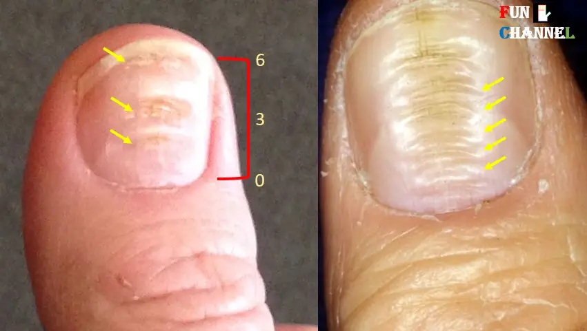 horizontal lines on fingernails