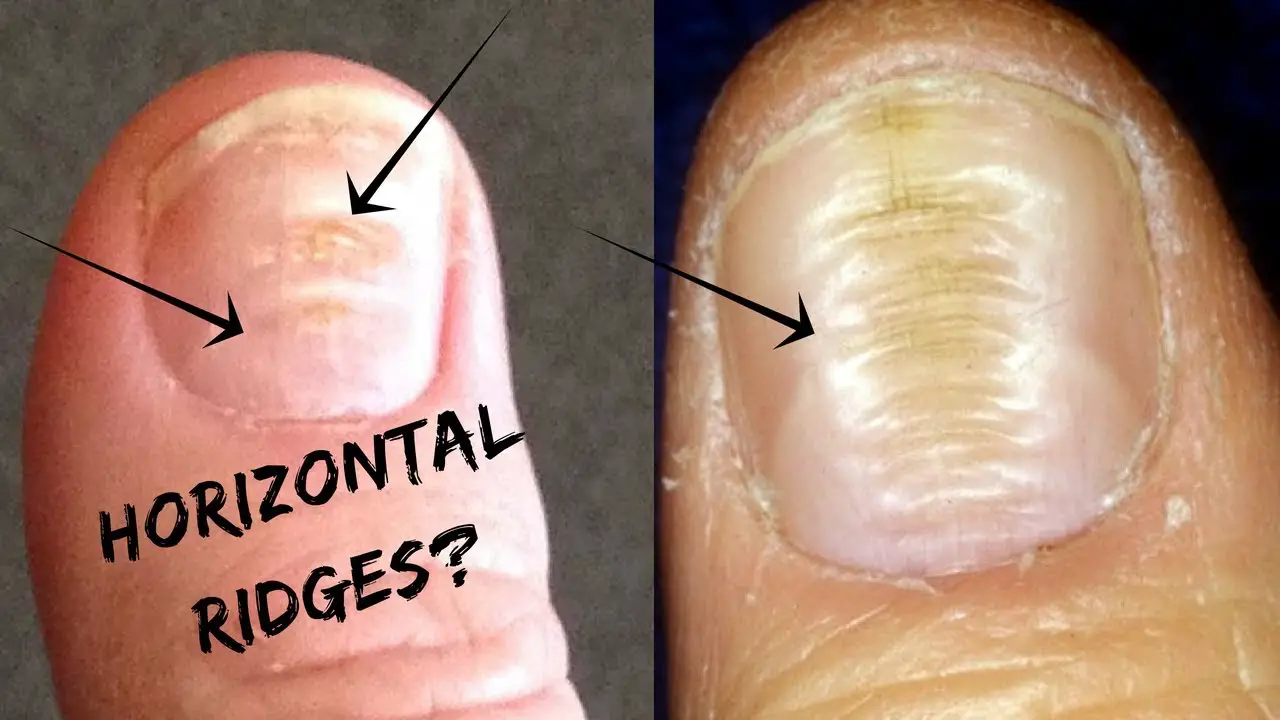 What Causes Horizontal Ridges On Your Nails