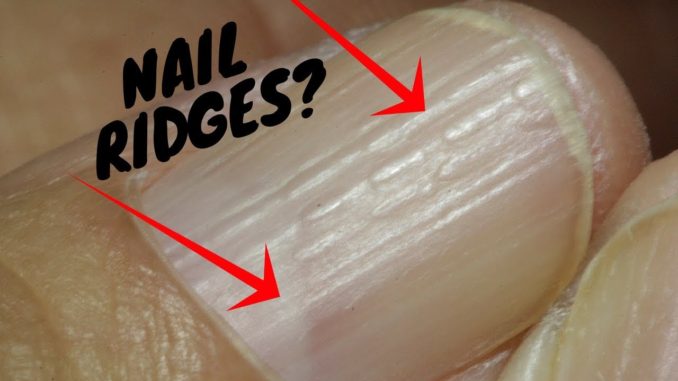 vertical-lines-in-nails-vitamin-deficiency-awesome-nail