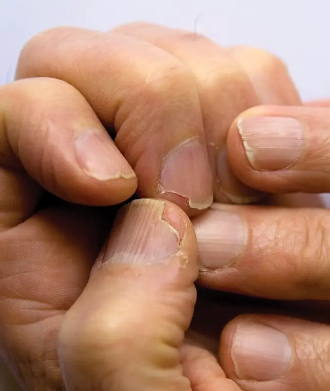 Brittle nails