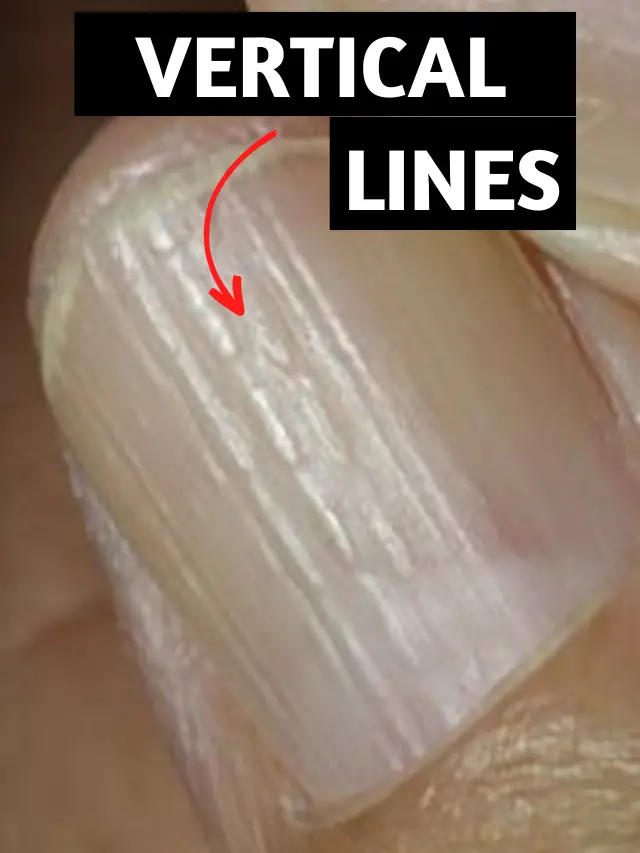 Vertical Lines On Nails And Their Causes